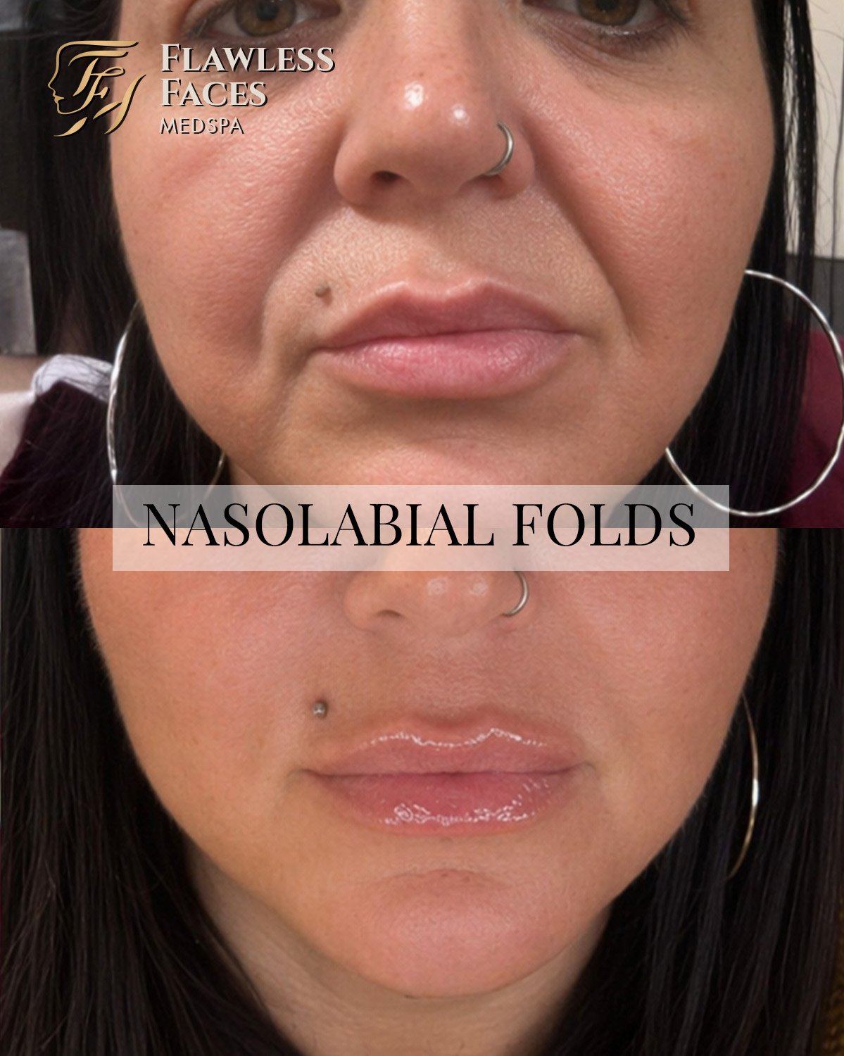 MAR Nasolabial filler 1